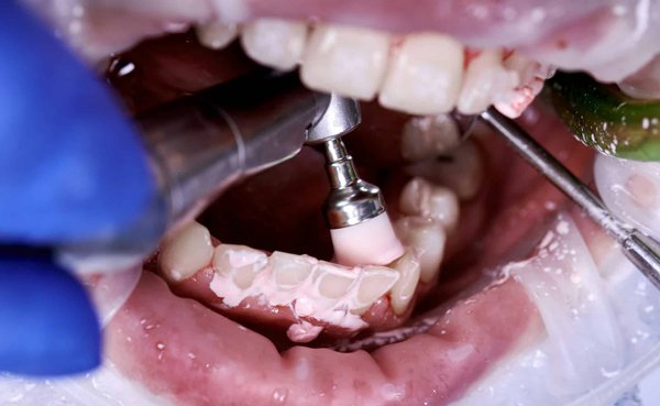 Comment se déroule un nettoyage dentaire professionnel à Gatineau-Hull ?